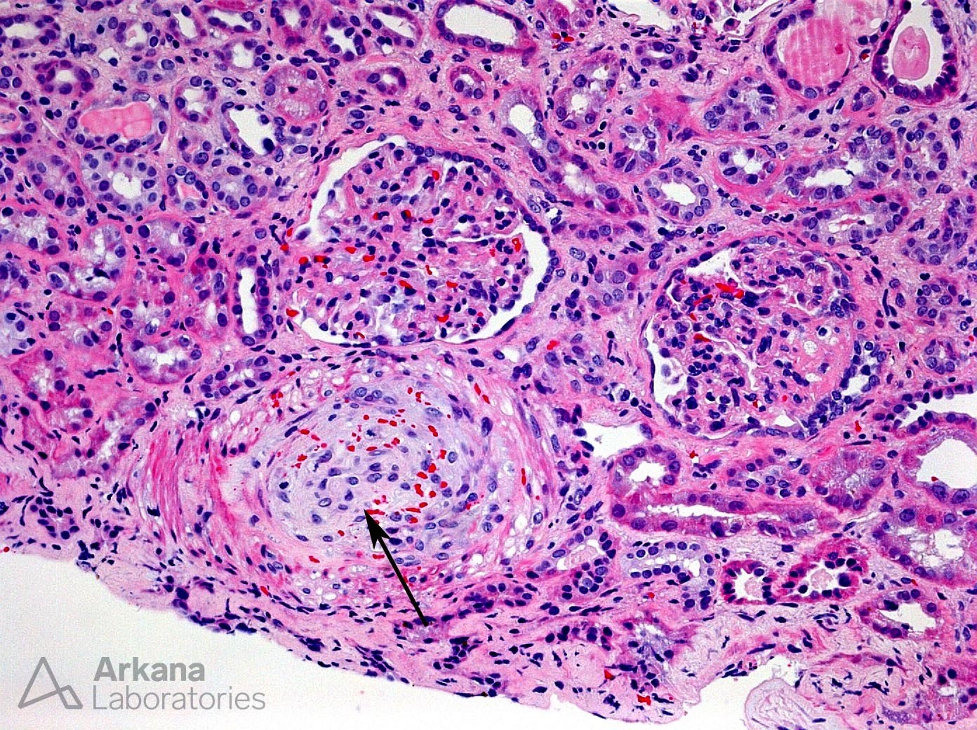Opana Associated TTP-Like Illness