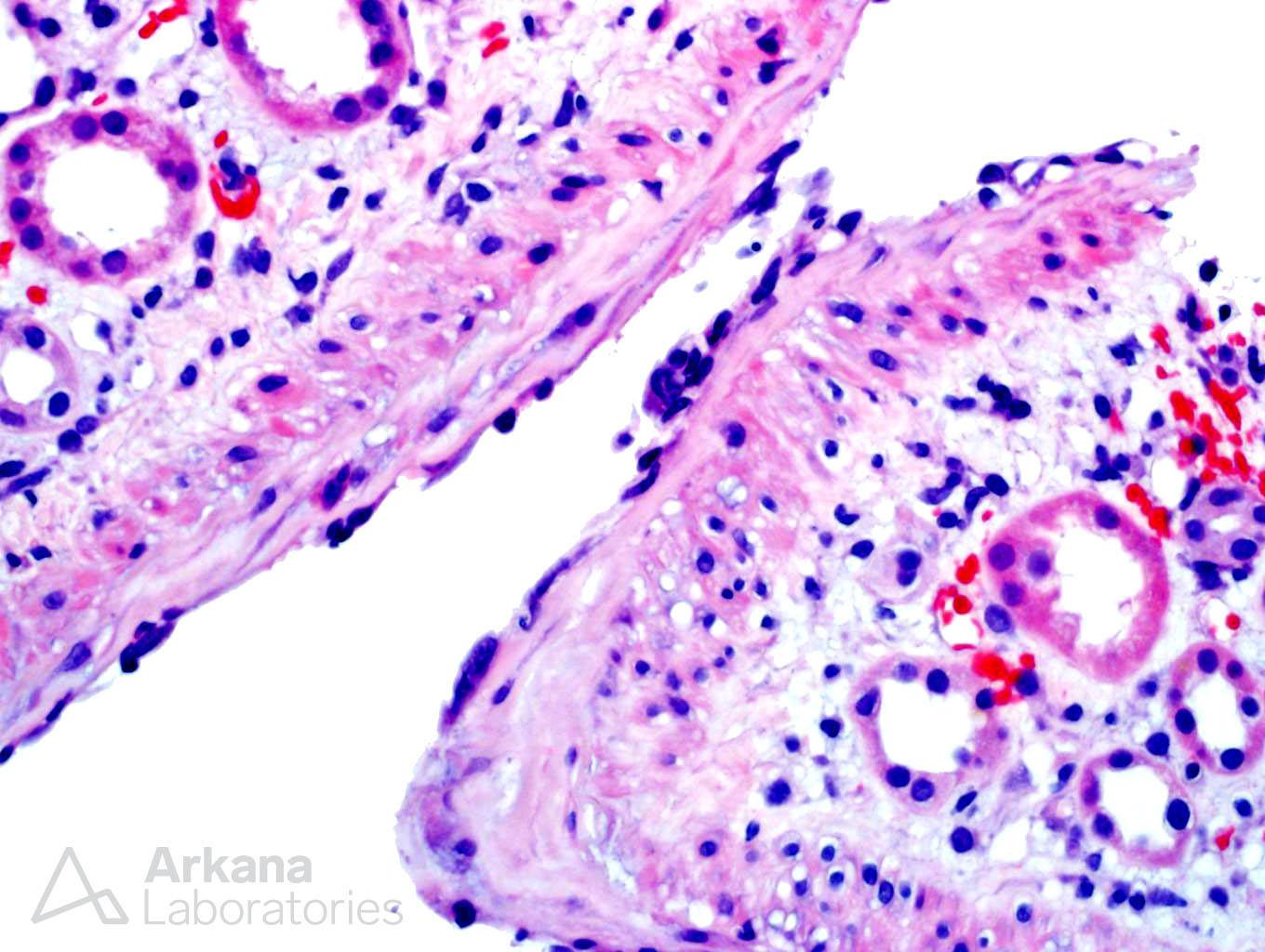 acute antibody-mediated rejection