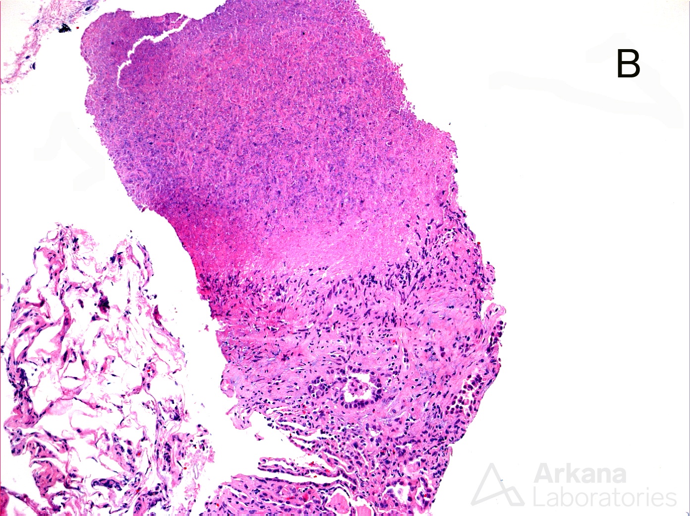 Tuberculosis - AFB and Rhodamine