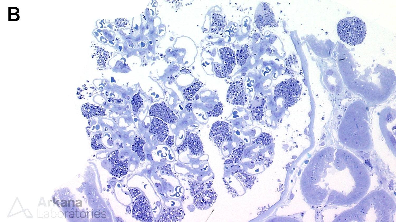 Fabry & Myelinosomes, Art of Medicine