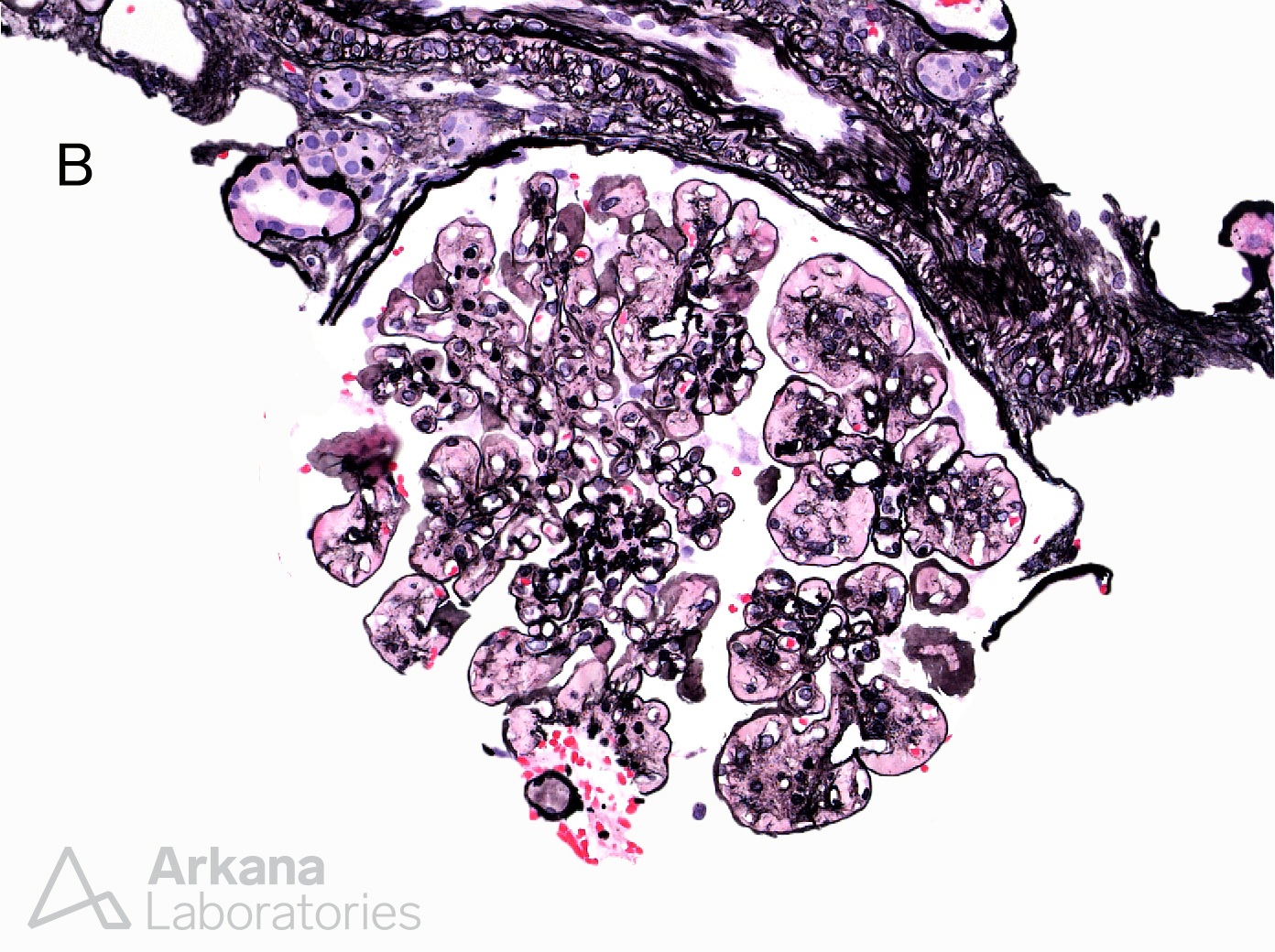 Fibronectin Glomerulopathy