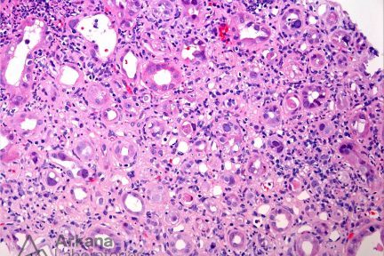 BK Nephritis with Nuclear Inclusions in a Transplant on H&E
