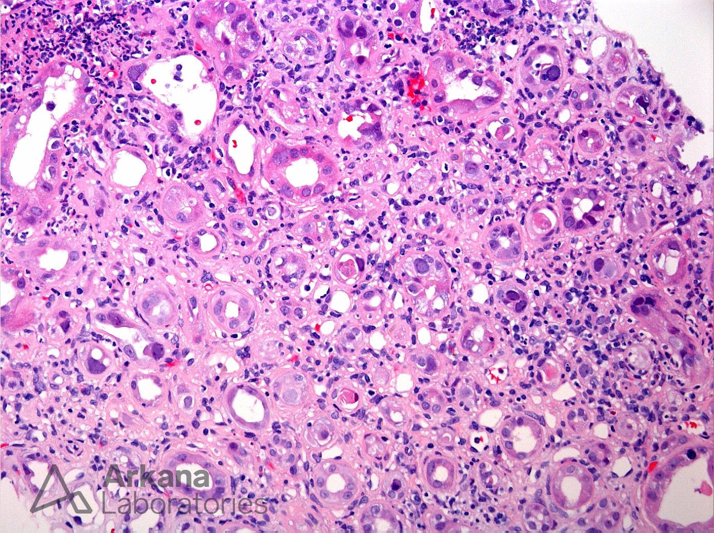 BK Nephritis with Nuclear Inclusions in a Transplant on H&E