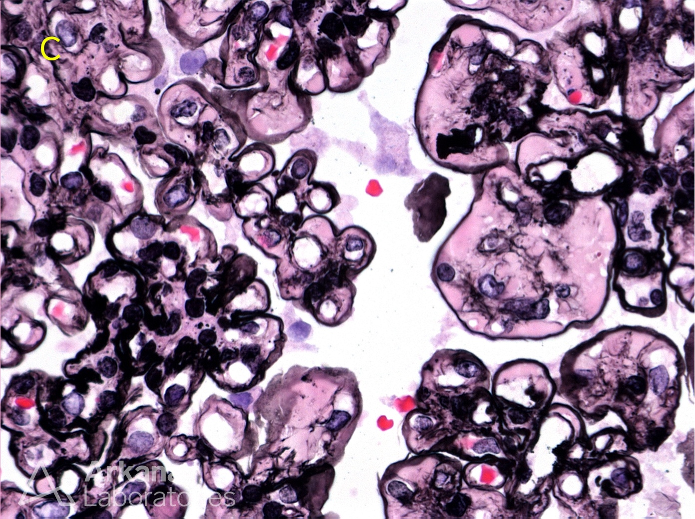 Fibronectin Glomerulopathy