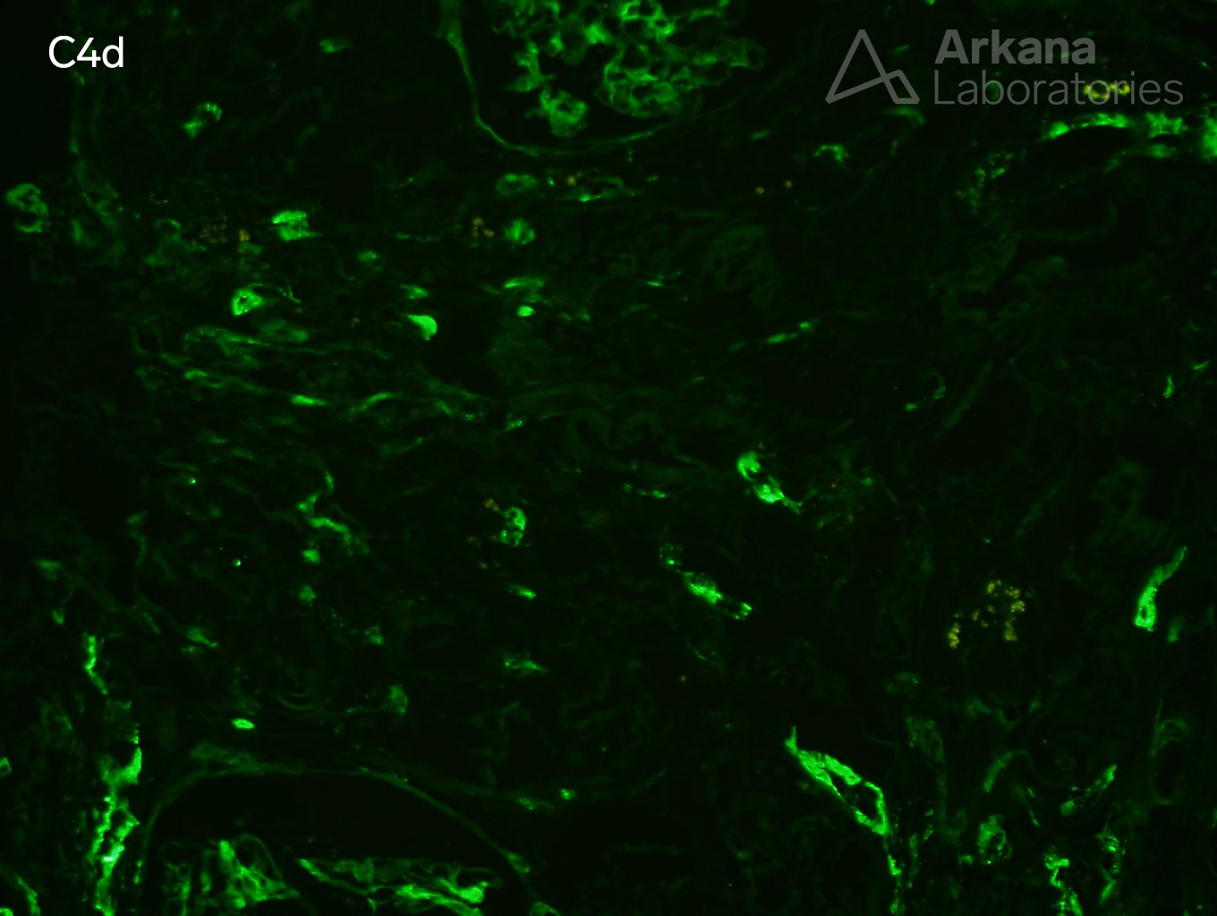 C4d stain showing acute antibody-mediated rejection