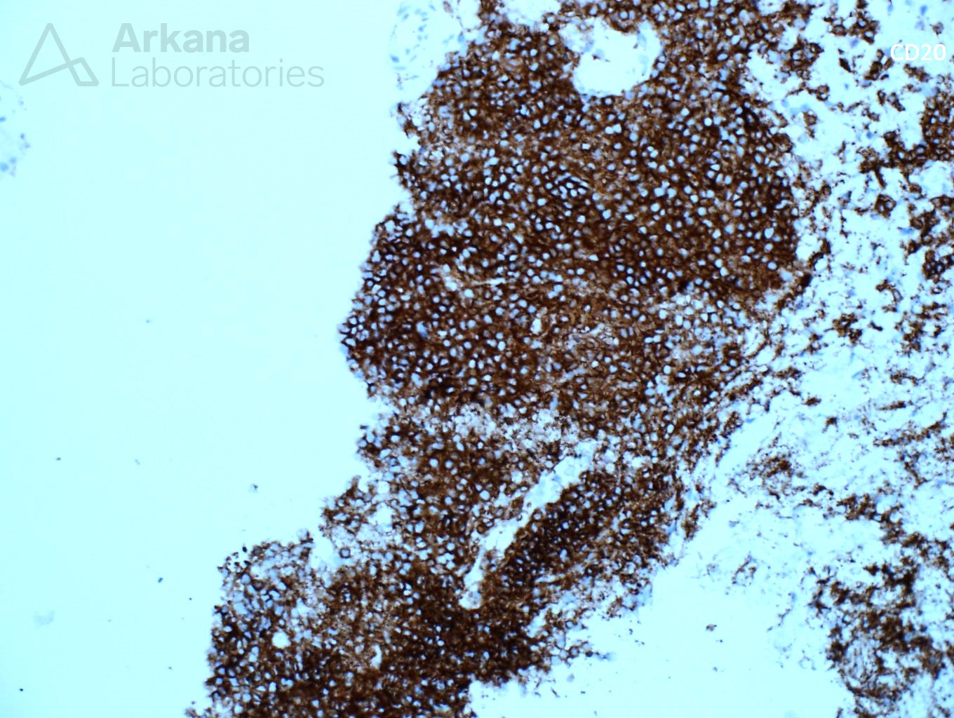 light chain deposition disease