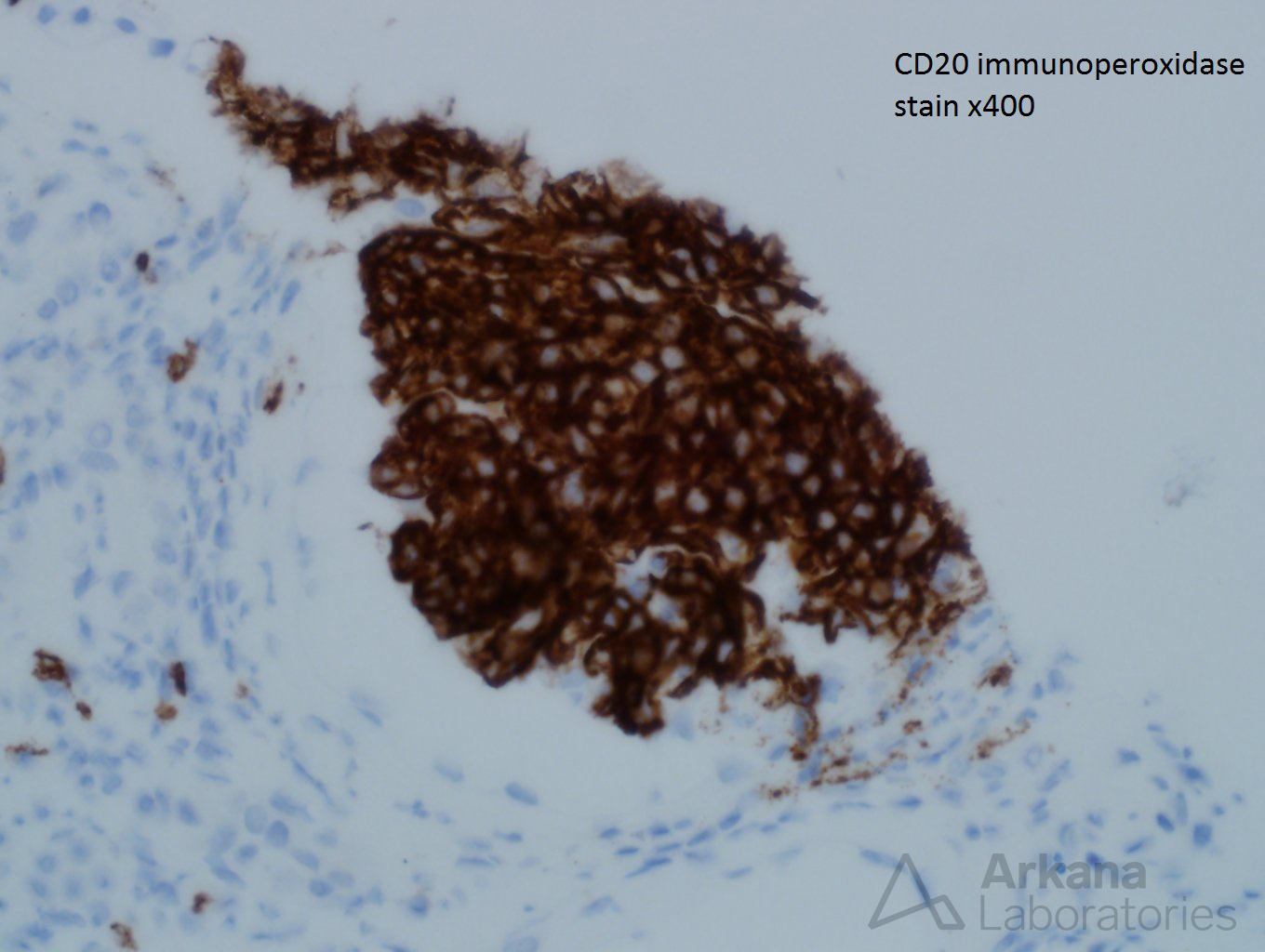 Large B-Cell Lymphoma