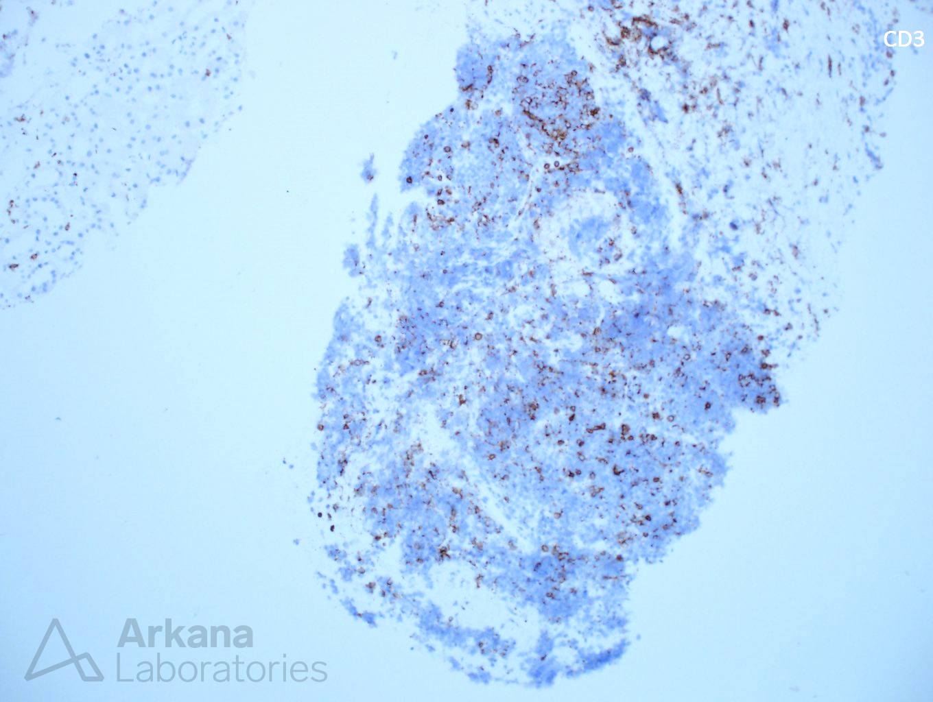 light chain deposition disease