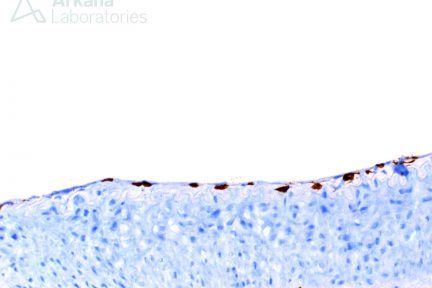 intimal arteritis