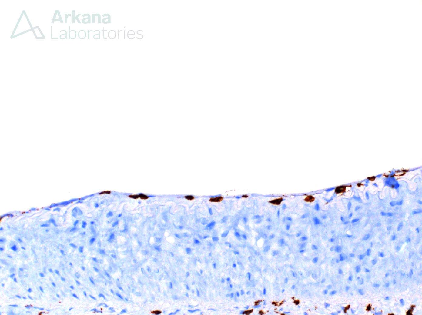 intimal arteritis