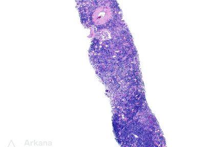 CLL/SLL, teaching points, arkana laboratories, renal pathology