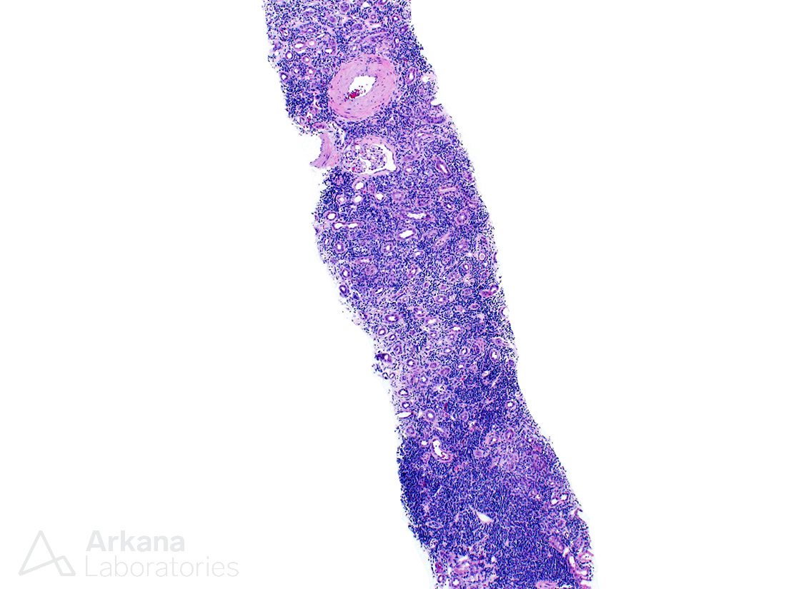 CLL/SLL, teaching points, arkana laboratories, renal pathology