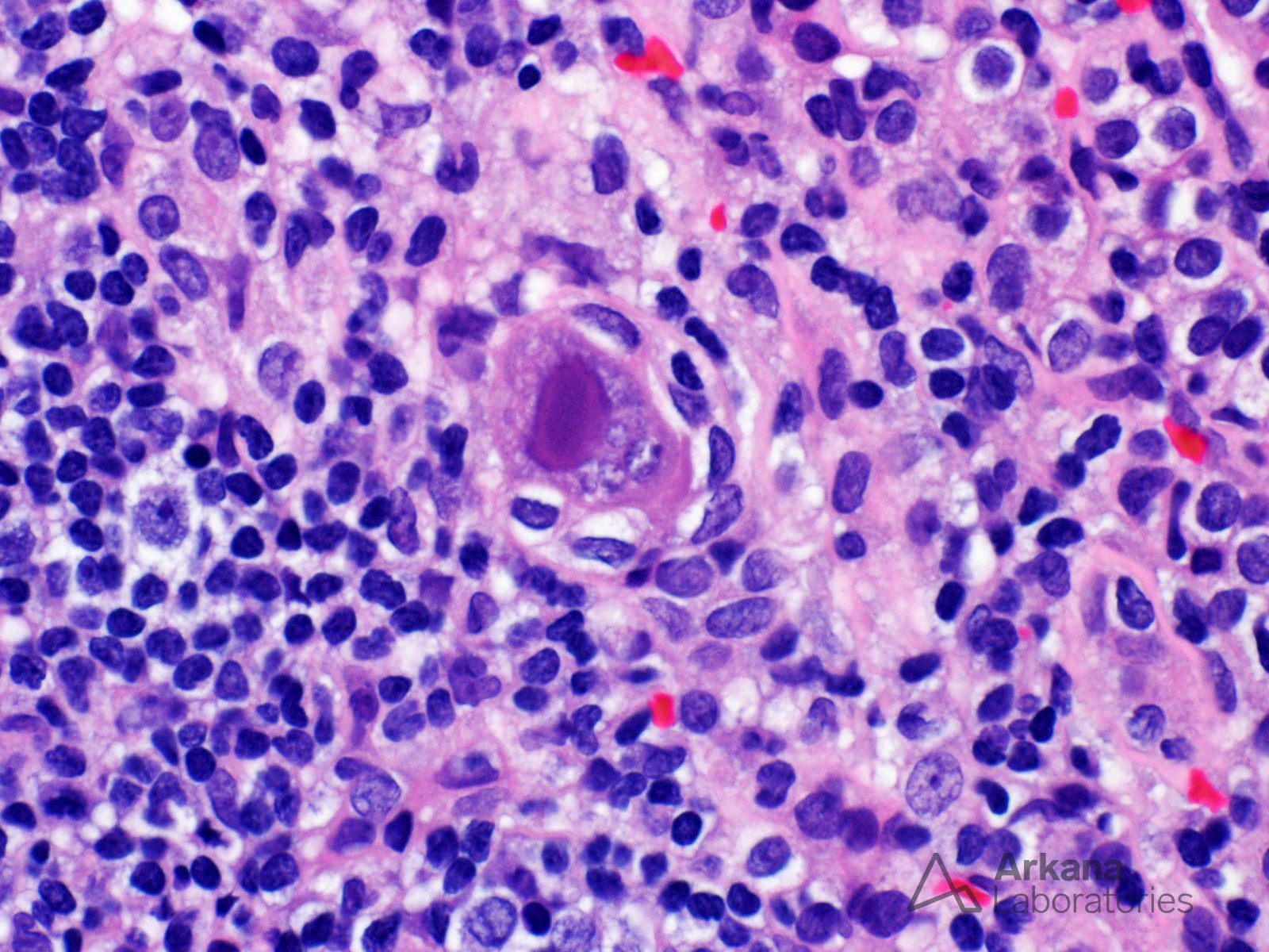 (CMV) Cytomegalovirus