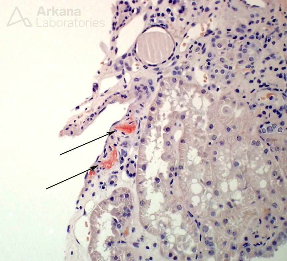 minimal amounts of amyloid deposits in biopsy of kidney at arkana laboratories, AL Amyloidosis