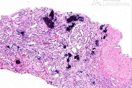 Nephrocalcinosis