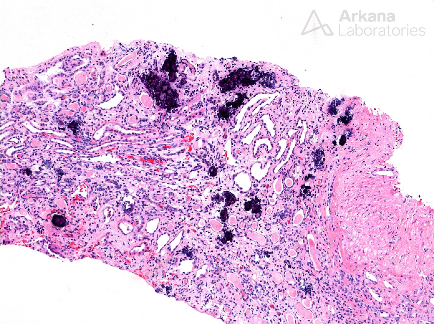 Nephrocalcinosis