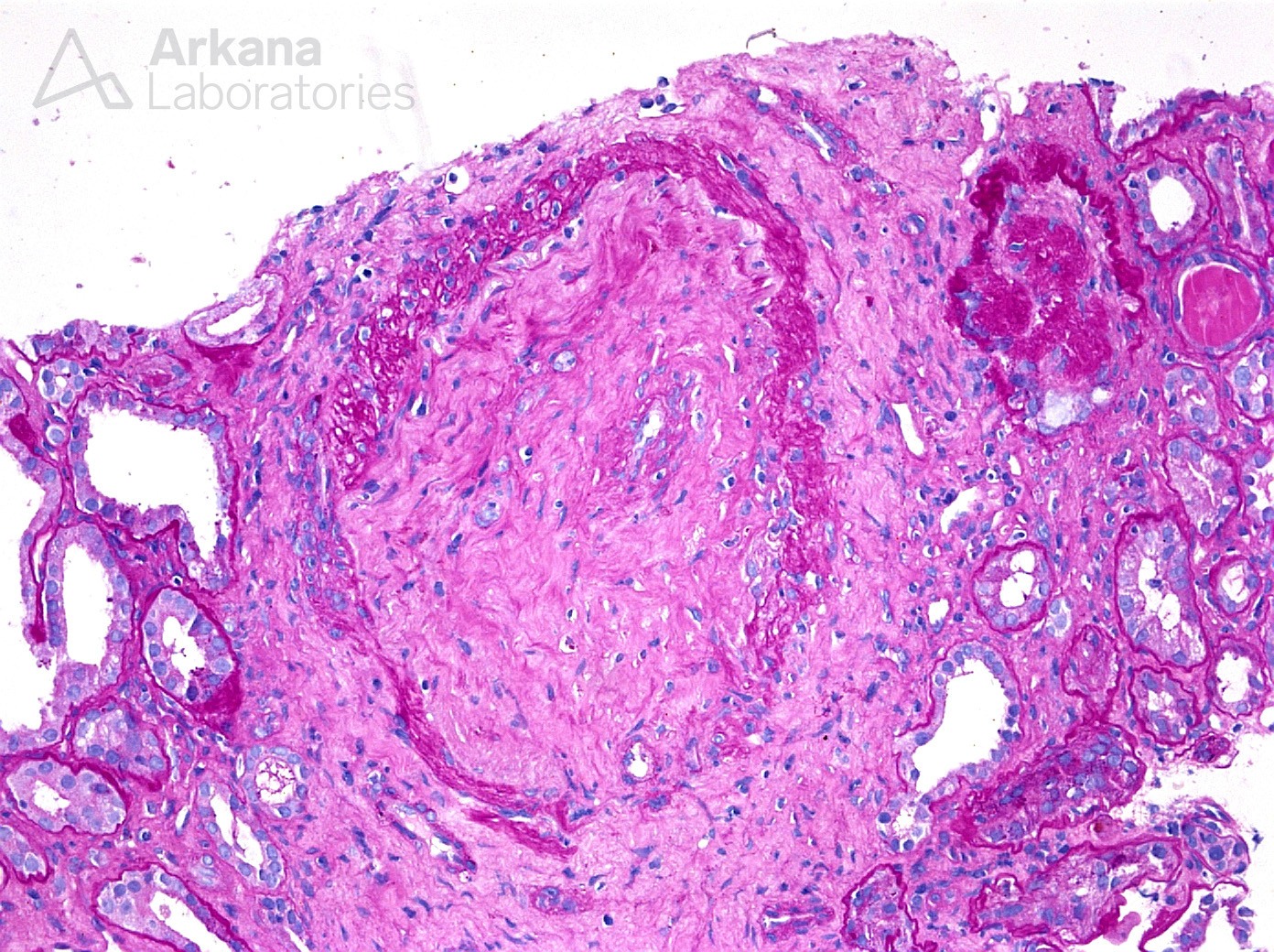 Arteritis