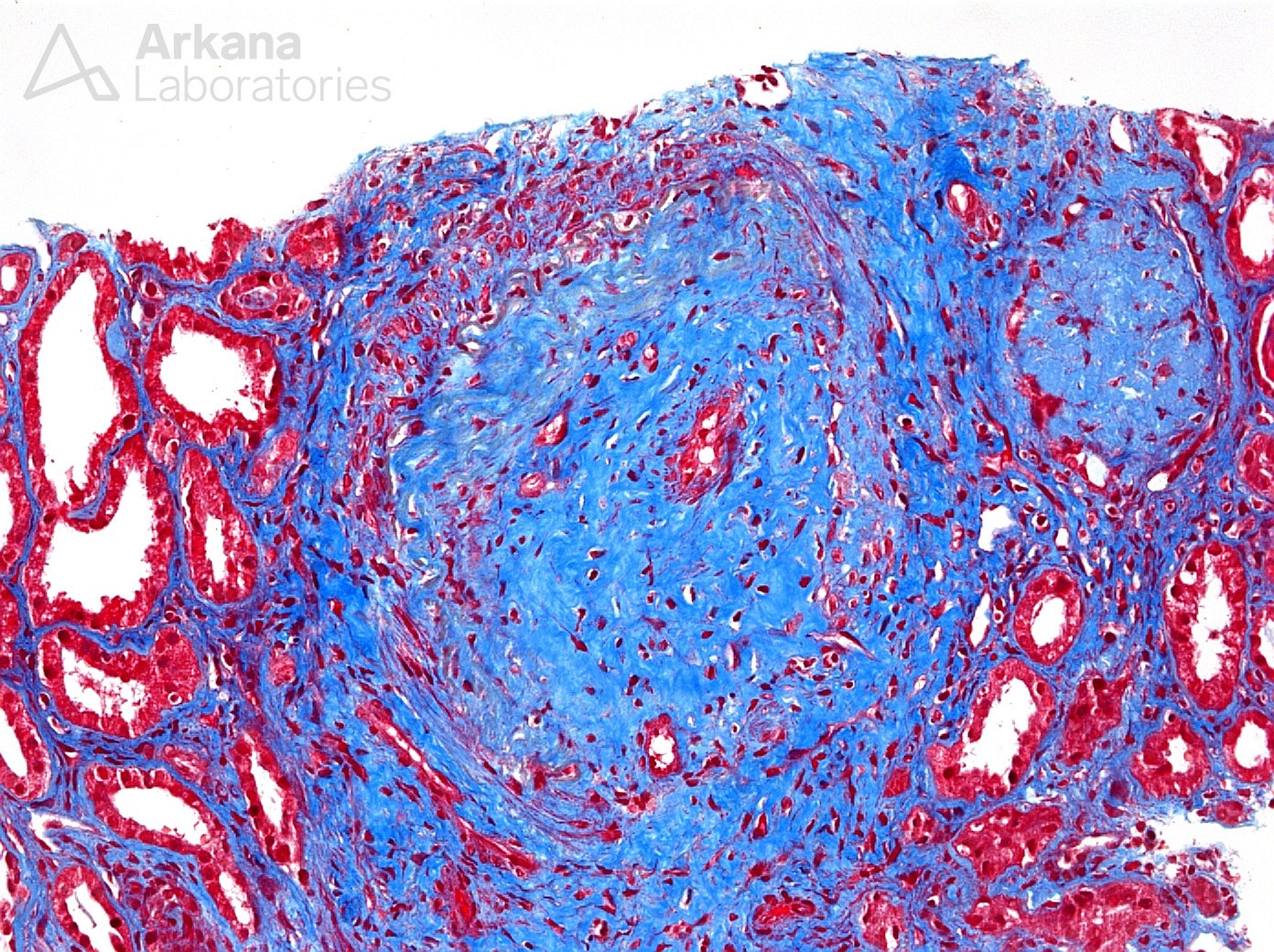 Arteritis