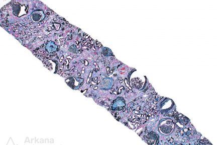 The “C” in Chronic Kidney Disease, CKD