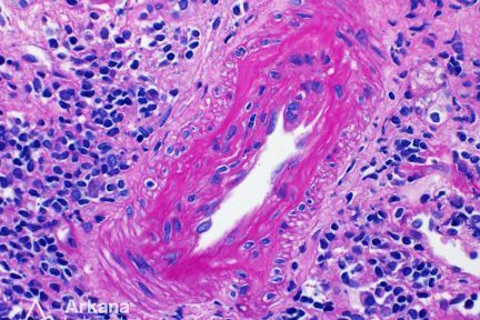 chronic transplant arteriopathy