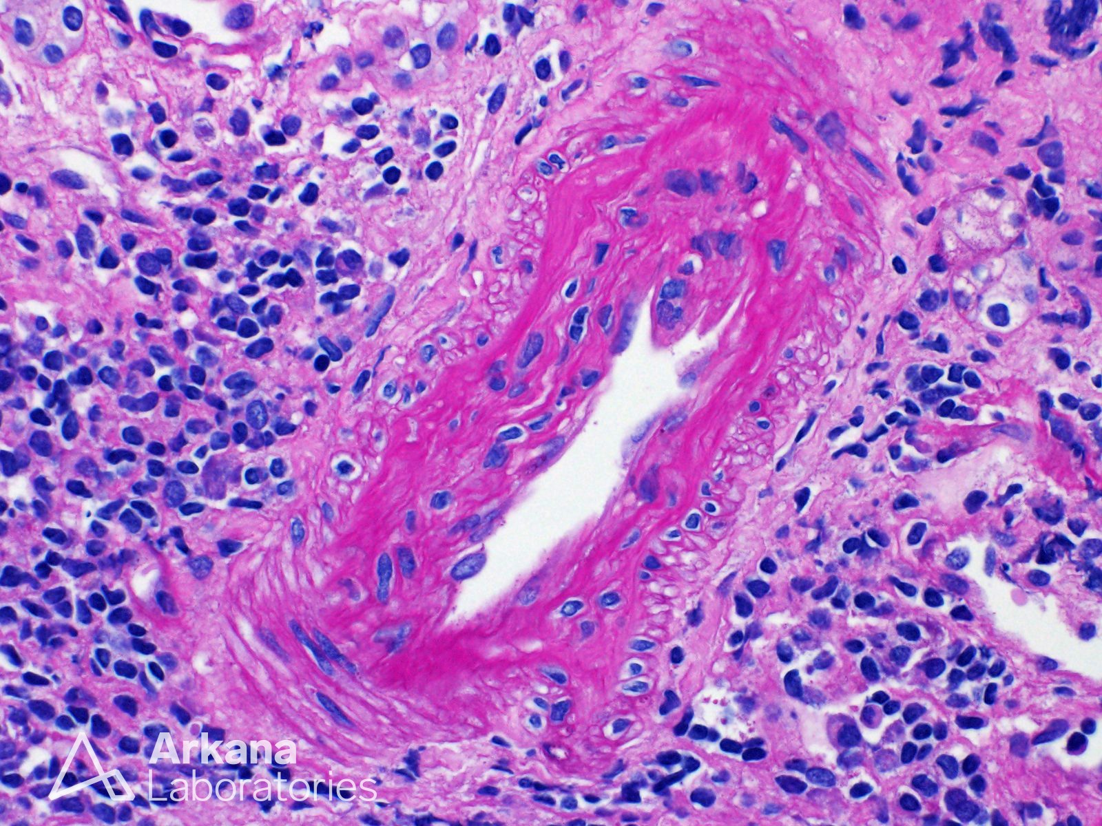 chronic transplant arteriopathy