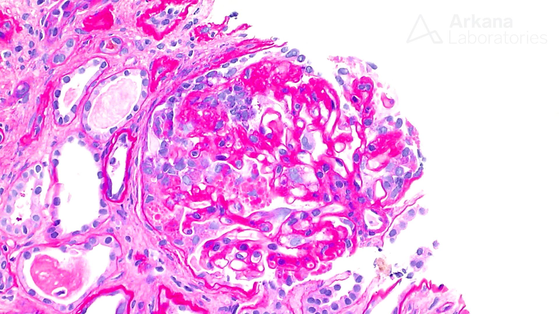 Collapsing Glomerulopathy, Arkana Laboratories, Art of Medicine