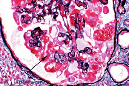 Collapsing glomerular lesions