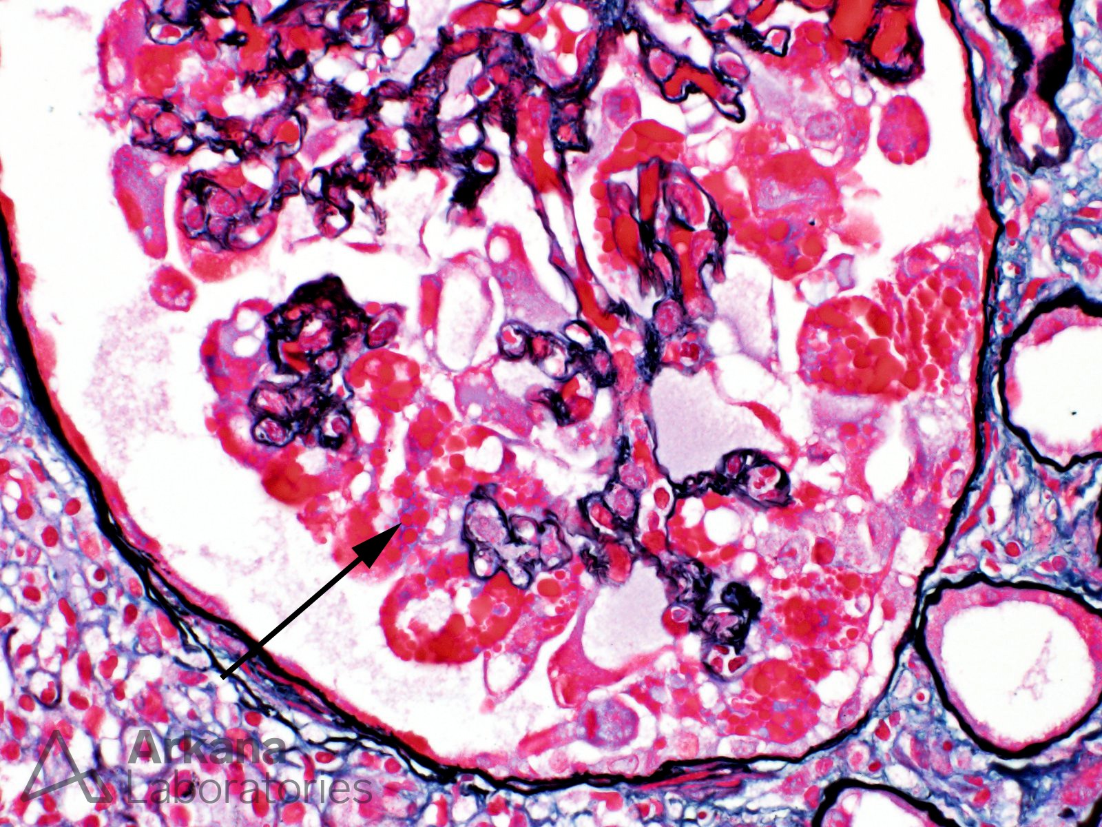 Collapsing glomerular lesions