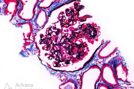 Collapsing Glomerulopathy