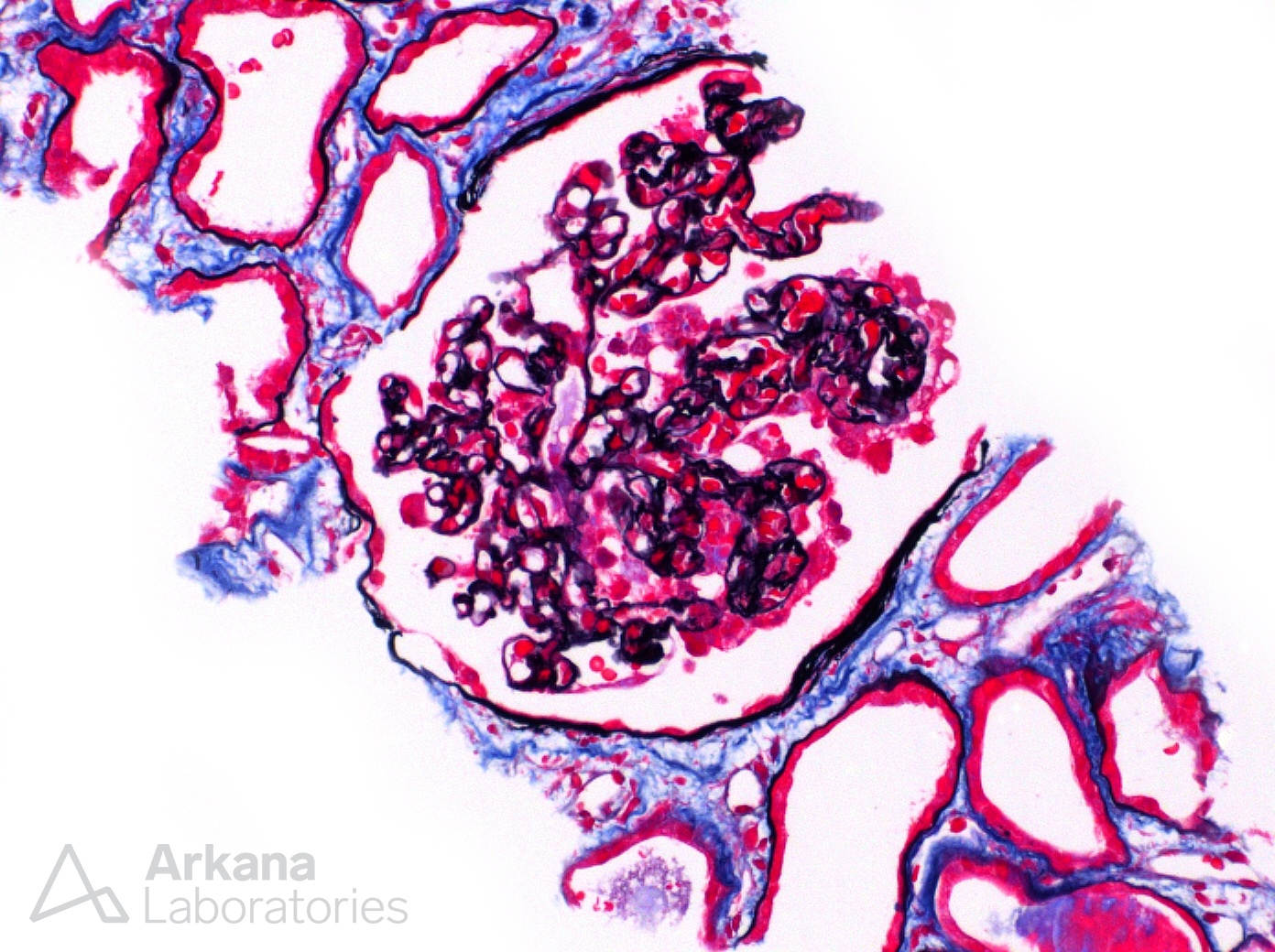 Collapsing Glomerulopathy