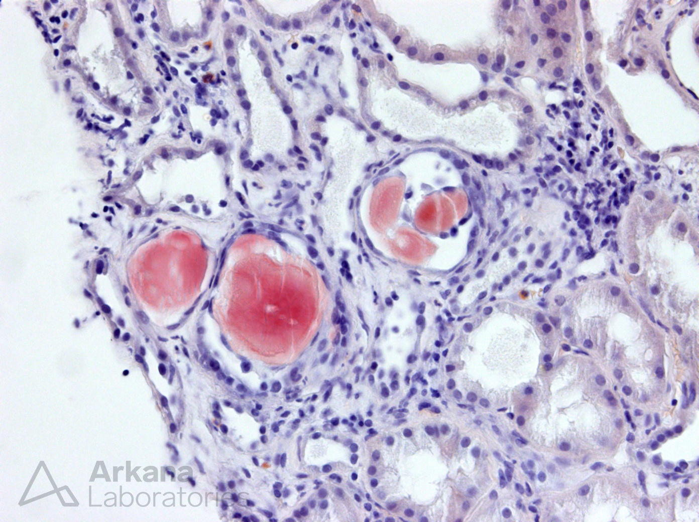 Amyloid Cast Nephropathy