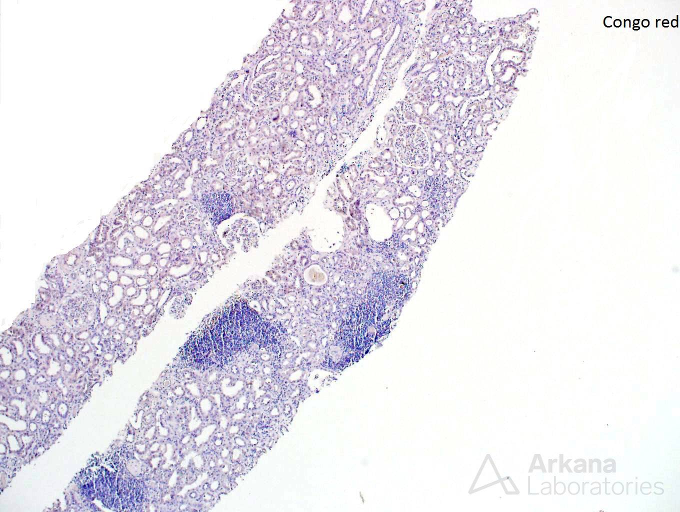 light chain deposition disease