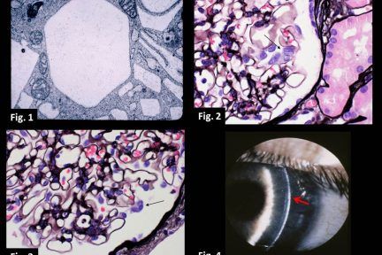 Cystinosis (CTNS)