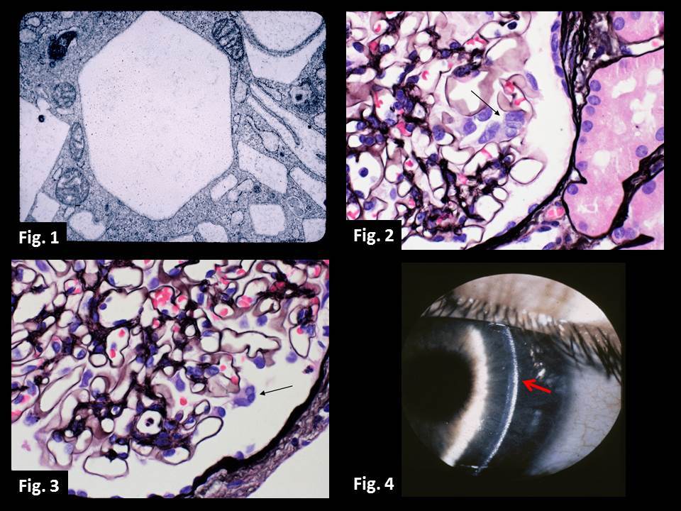 Cystinosis (CTNS)