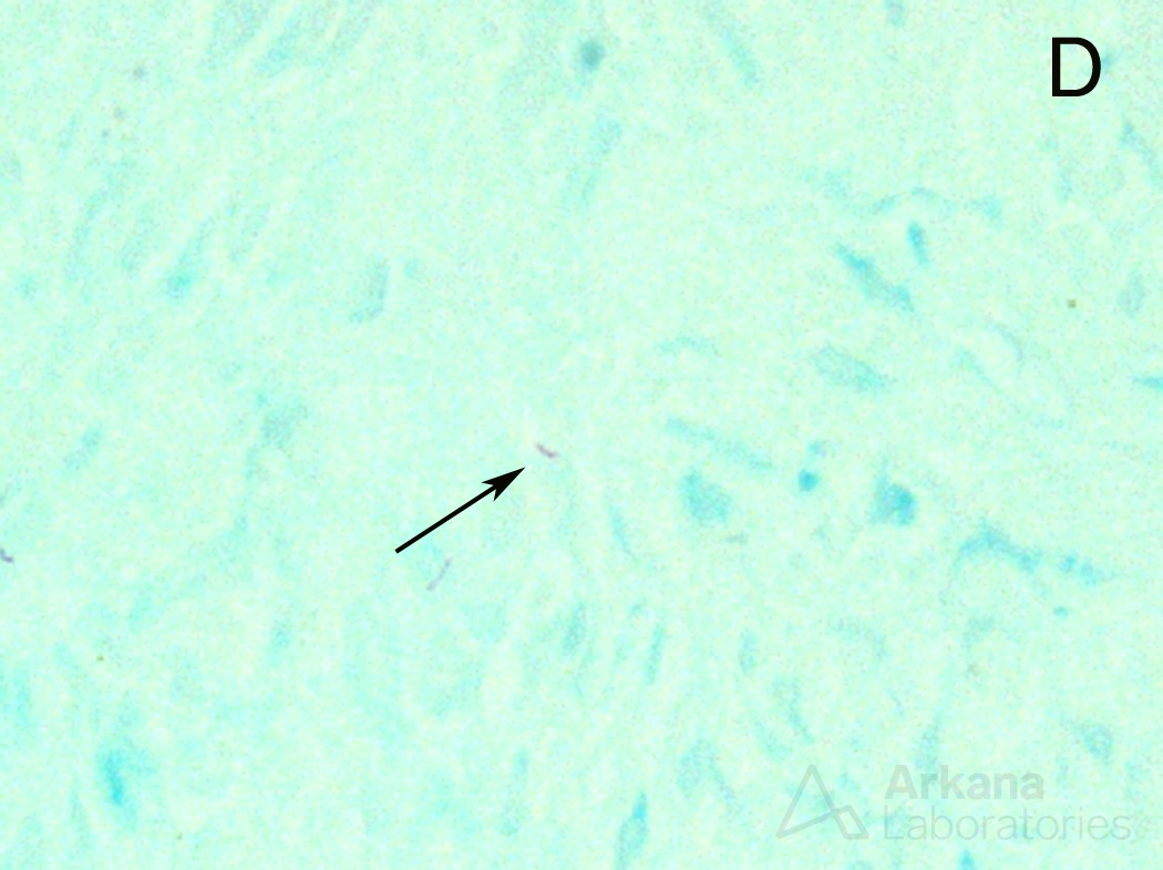 Tuberculosis - AFB and Rhodamine