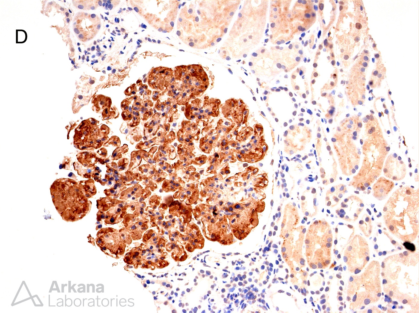 Fibronectin Glomerulopathy