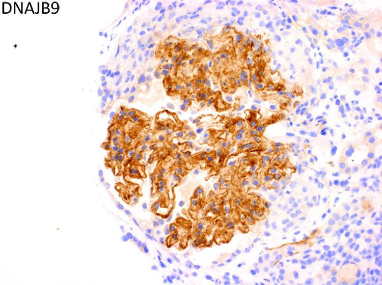 Fibrillary Glomerulopathy, DNAJB9 stain