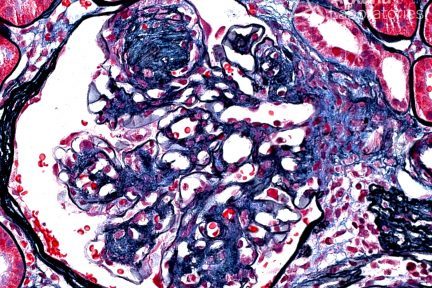 Diffuse and Nodular Glomerulosclerosis in Diabetic Glomerulopathy