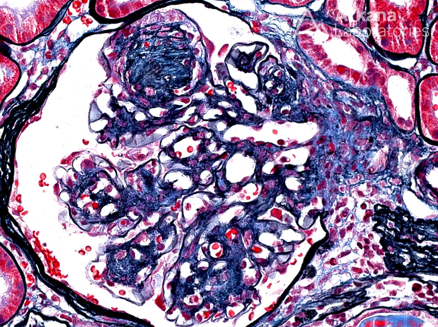 Diffuse and Nodular Glomerulosclerosis in Diabetic Glomerulopathy