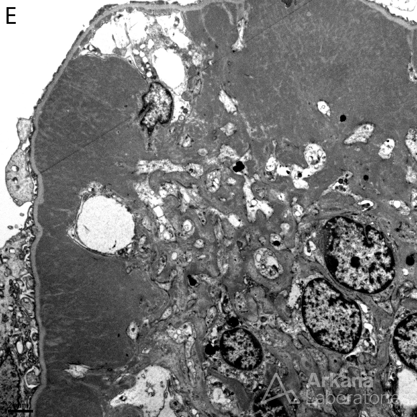 Fibronectin Glomerulopathy