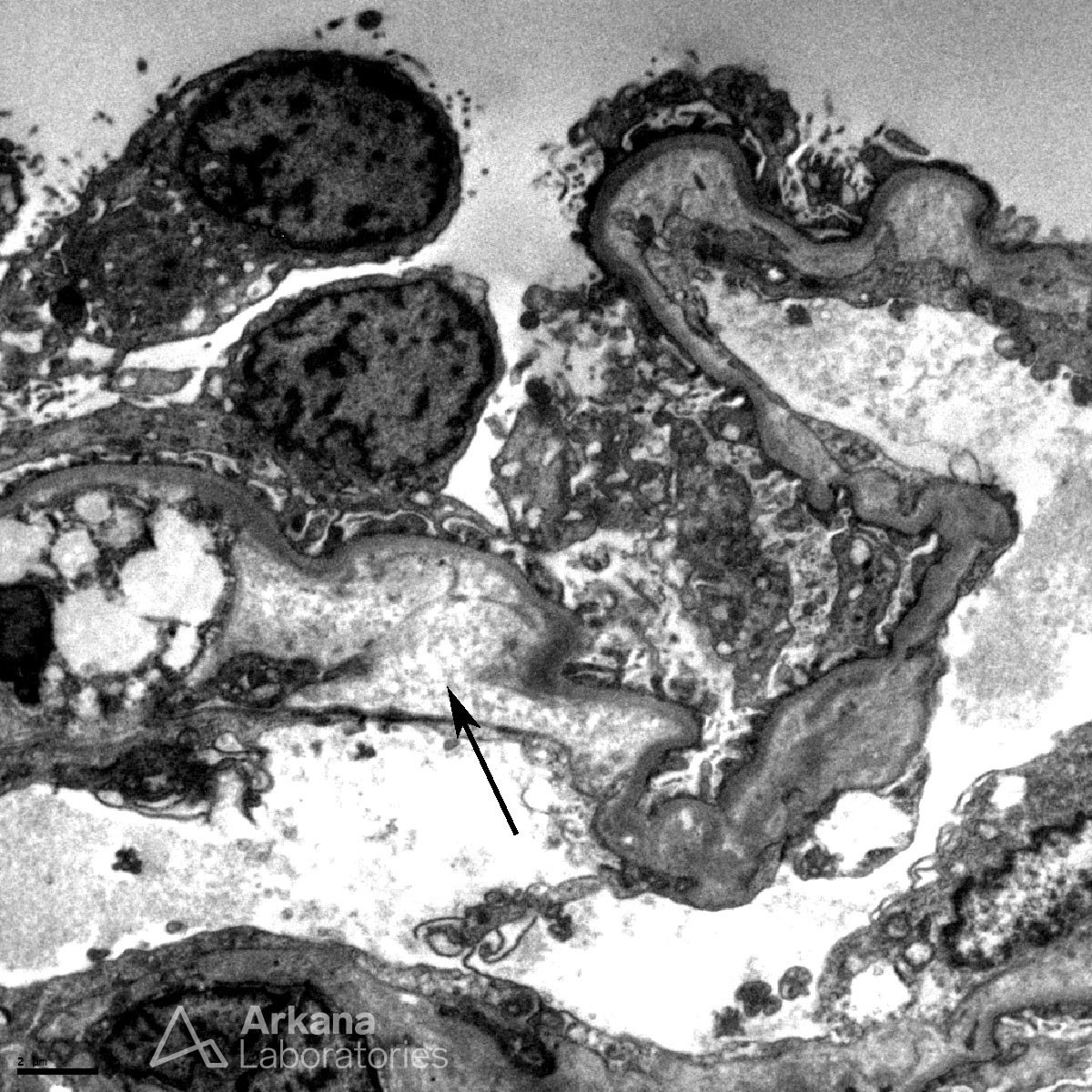 Opana Associated TTP-Like Illness