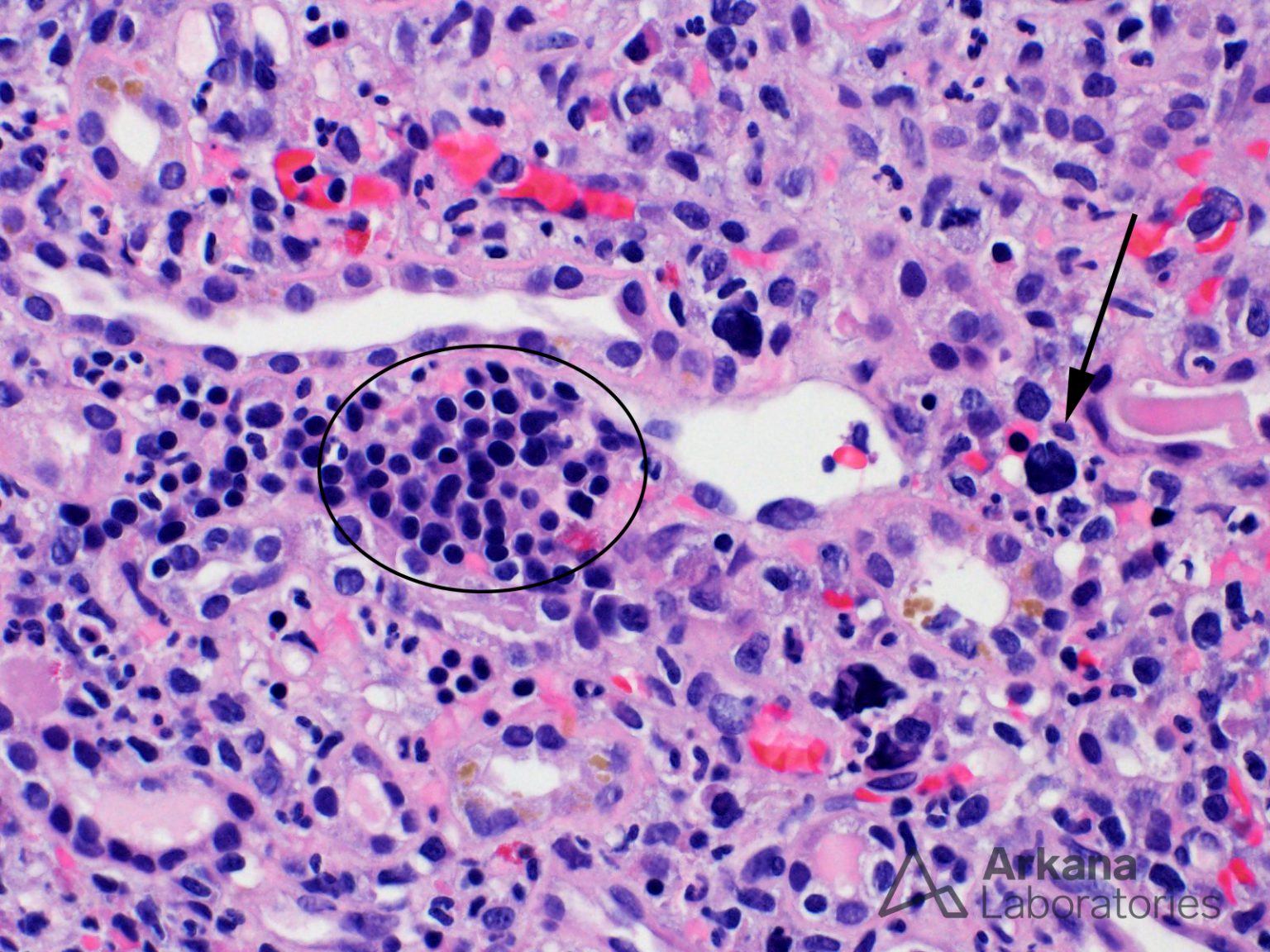 Extramedullary Hematopoiesis Teaching Points Arkana Laboratories