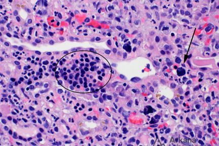 Extramedullary Hematopoiesis