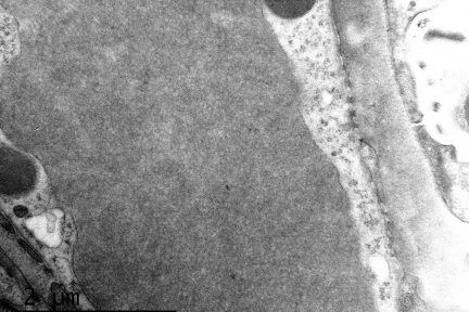 Cryoglobulinemic glomerulonephritis