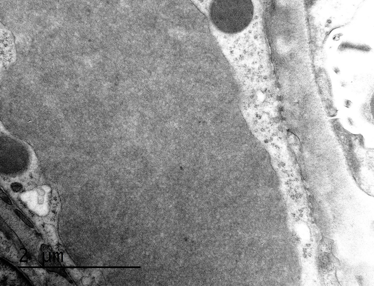 Cryoglobulinemic glomerulonephritis