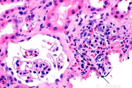 Interstitial Eosinophils