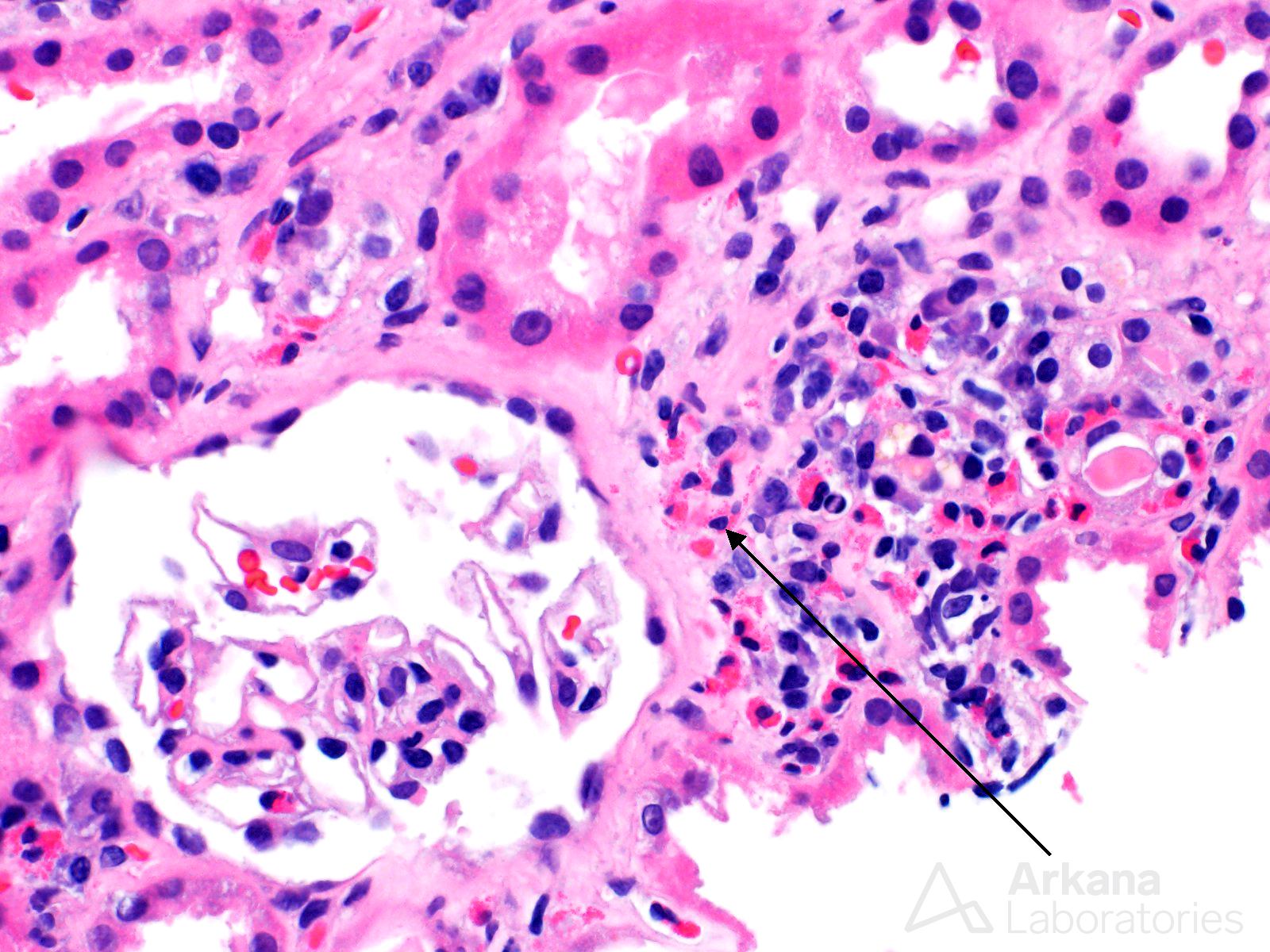 Interstitial Eosinophils