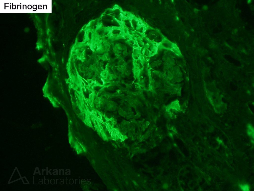 ANCA serologies, steroid therapy, staining, imaging, pathology, arkana laboratories