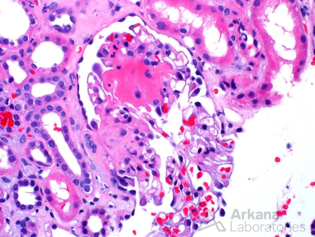 fibrinoid necrosis, renal pathology, diagnosing patients, arkana laboratories