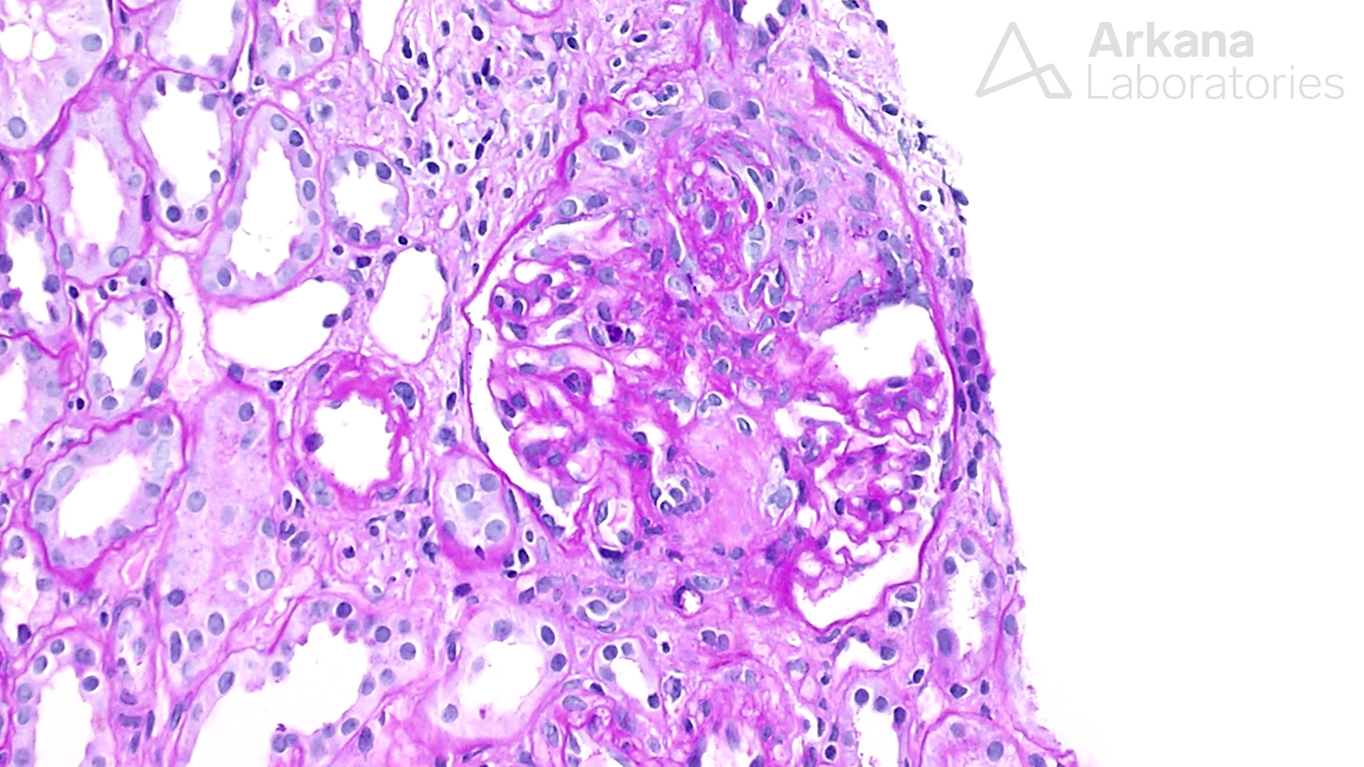 renal biopsy for ANCA-Associated Glomerulonephritis